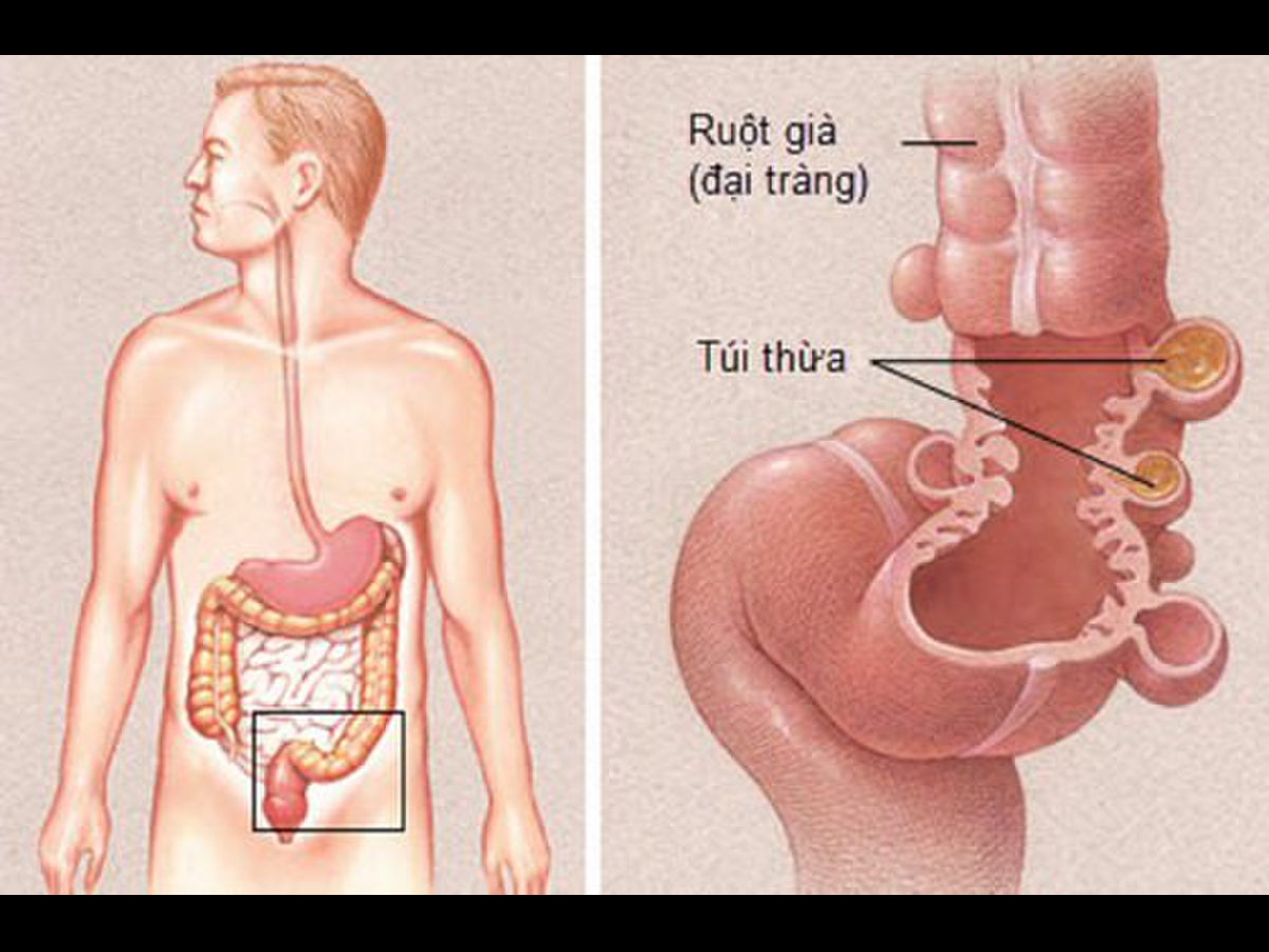 Bệnh túi thừa đại tràng